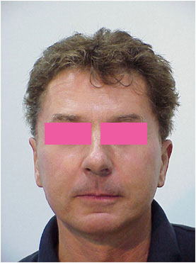 forehead lift, neck lift